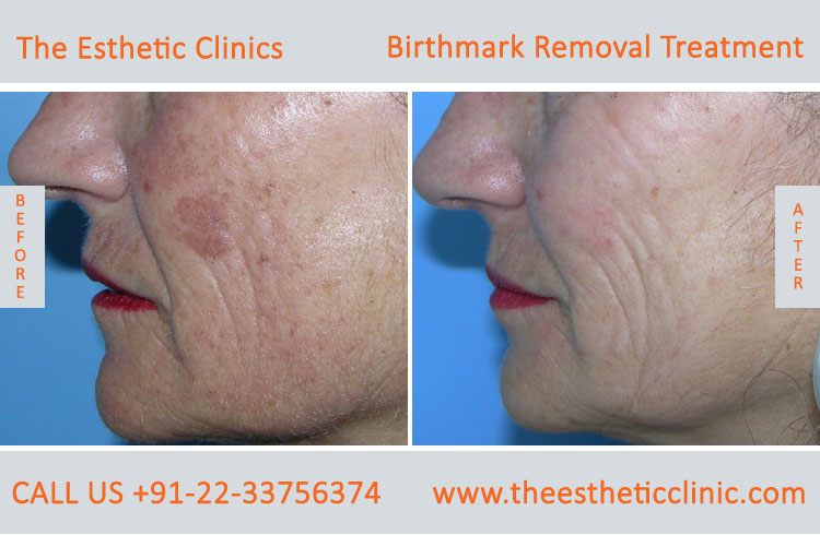 Birthmarks Removal Treatment before after photos in mumbai india (5)